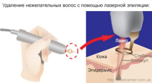 Лазерная эпиляция Киев